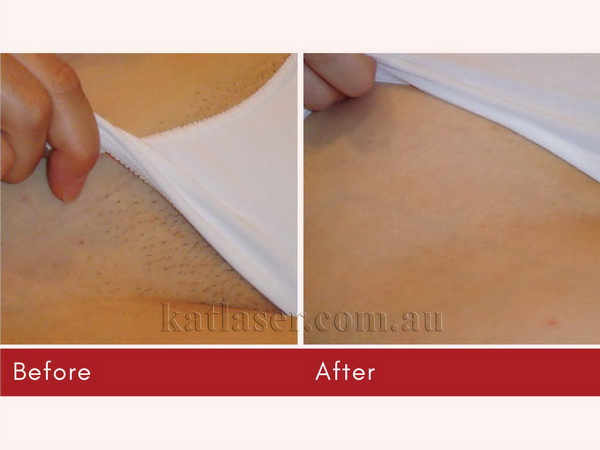 Before After HAIR REMOVAL 6