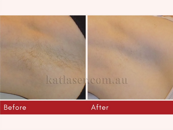 Before After HAIR REMOVAL 3