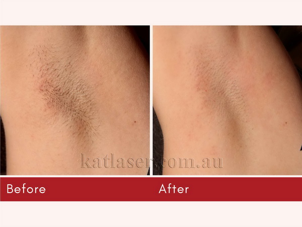 Before After HAIR REMOVAL 1