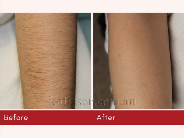 Before After HAIR REMOVAL 4