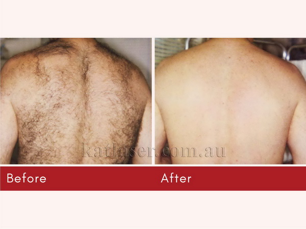 Before After HAIR REMOVAL 8