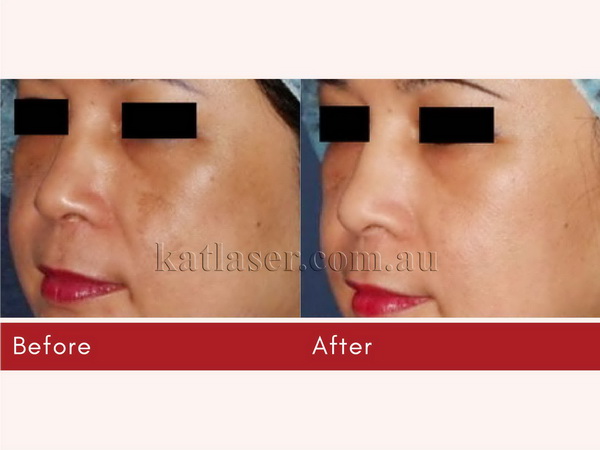 Before After PICOSURE SKIN 5