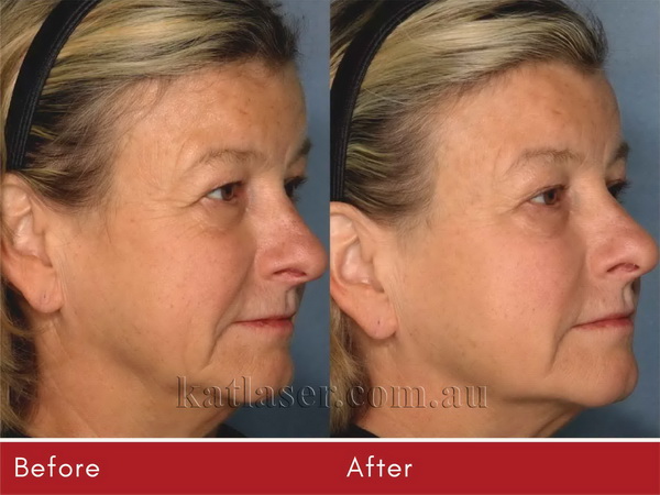 Before After PICOSURE SKIN 2