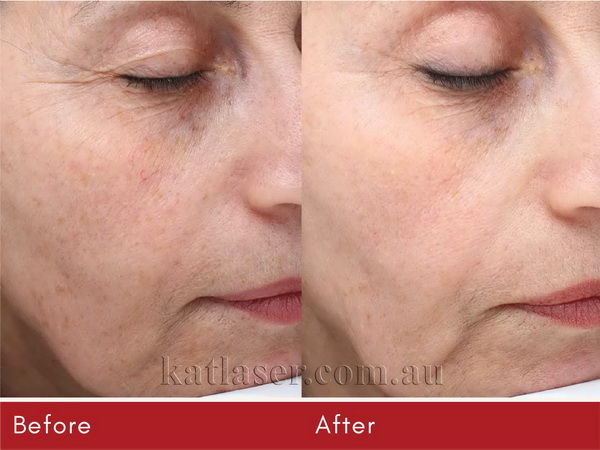 Before after PICOSURE SKIN 1