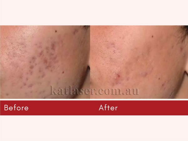 Before After PICOSURE SKIN 7