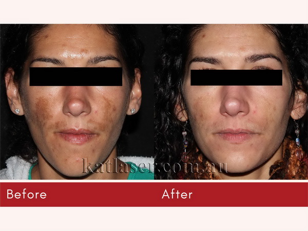 Before After PICOSURE SKIN 3