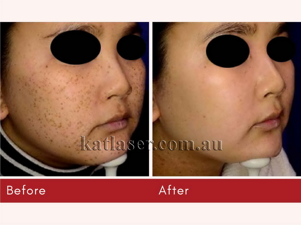 Before After PICOSURE SKIN 6