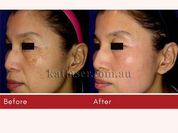 Before After PICOSURE SKIN 4