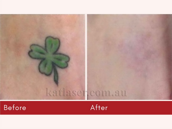 Before After TATTOO REMOVAL 1