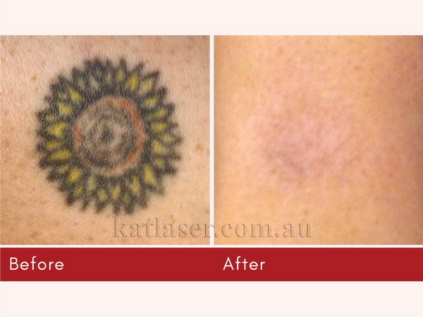 Before After TATTOO REMOVAL 2