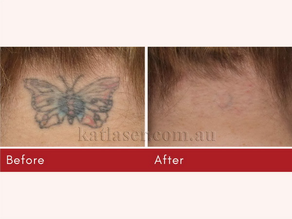 Before After TATTOO REMOVAL 5