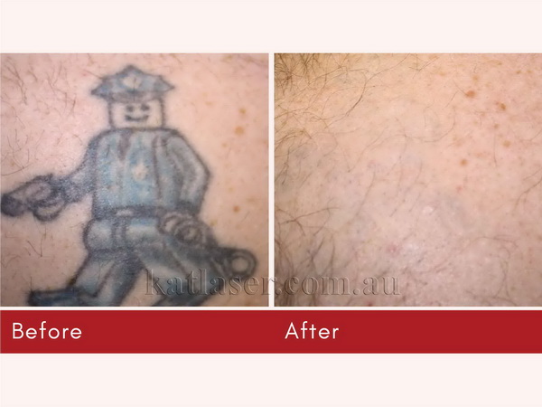 Before After TATTOO REMOVAL 4