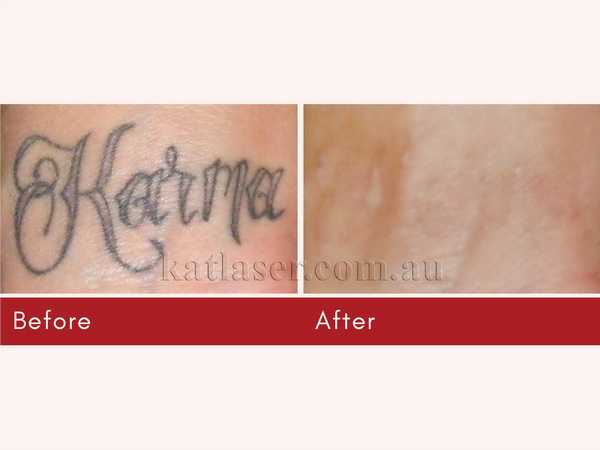Before After TATTOO REMOVAL 6