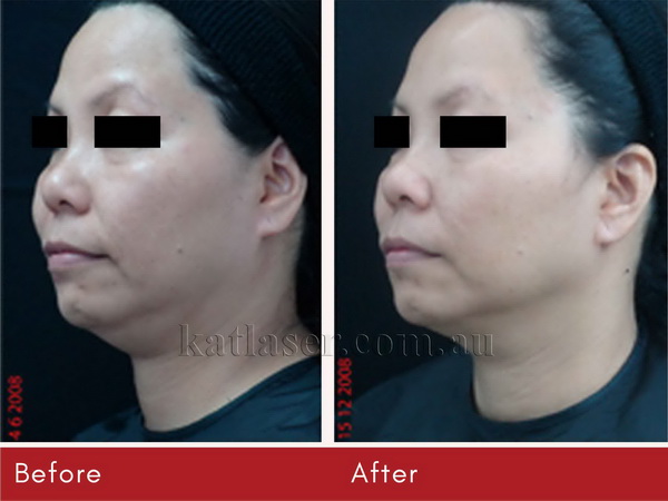 Before After THERMAGE 2