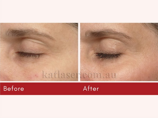 Before After THERMAGE 3