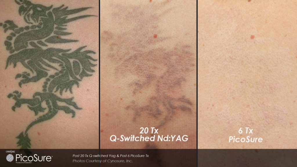 Oasis Laser Tattoo Removal  Laser Tattoo Removal Progress BLACK vs RED Ink  Tattoo  While black tattoos are easier to remove colored tattoos double  the treatment for complete removal Dont forget