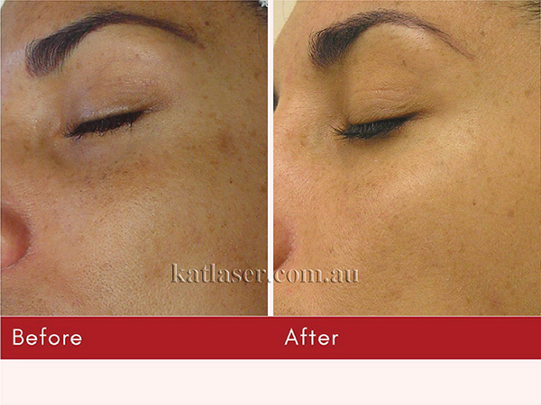 HYDRAFACIAL-01