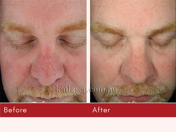 HYDRAFACIAL-02