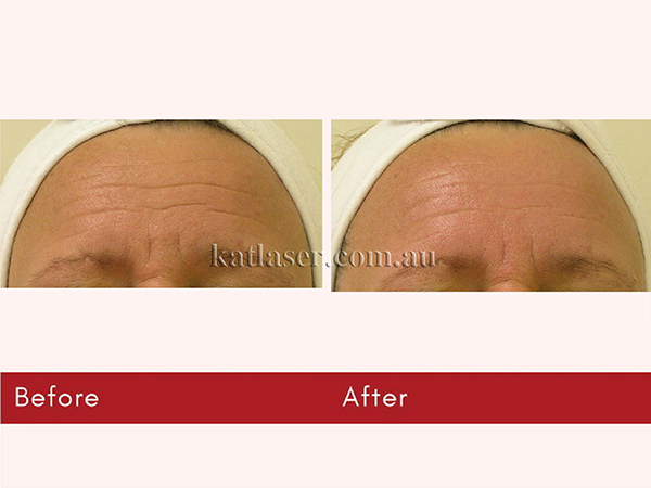 HYDRAFACIAL-03