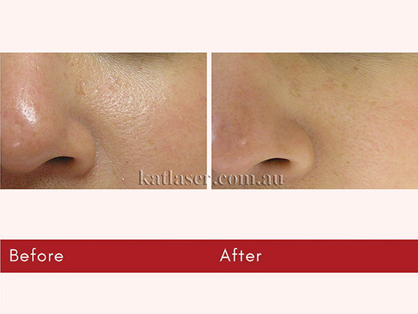 HYDRAFACIAL-04